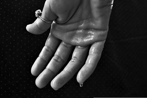 Hiperhidrosis palmar cirugía